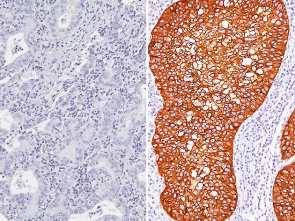 Desmoglein 3 + CK5 Antibody